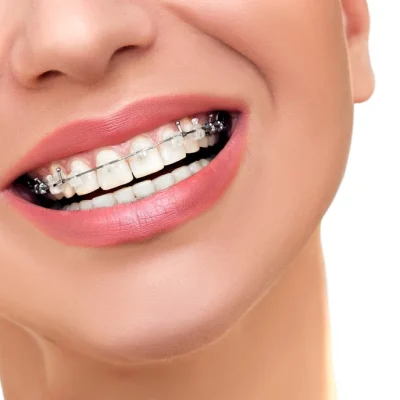 Ortodoncia-brackets